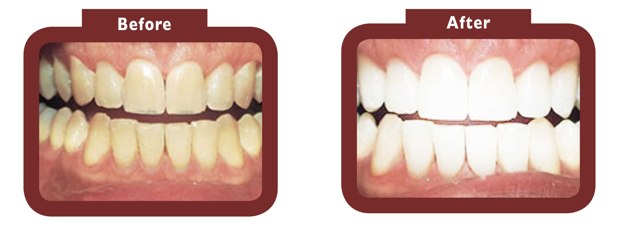 See LA Teeth Whitening before and after results. Contact our team today! Dunstable