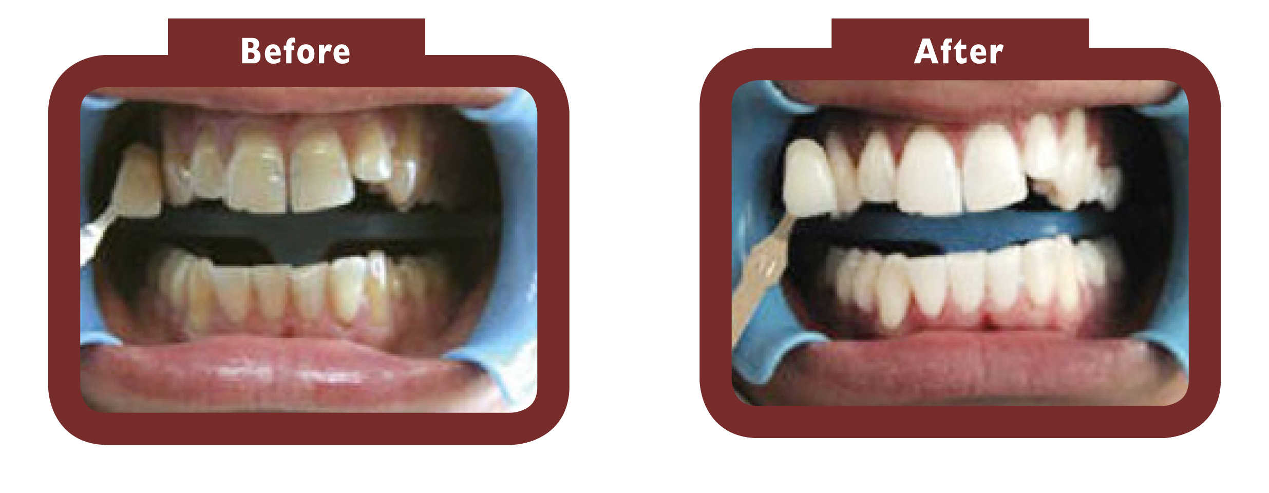 Before and after teeth whitening Dunstable - LA TEETH Dunstable