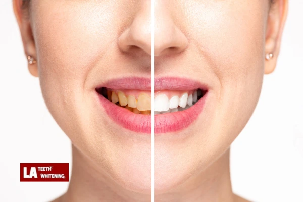 About Us At LA Teeth Whitening Dunstable Contact us today! Dunstable