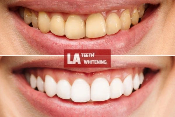 Before and after results - smokers stained teeth results! Dunstable