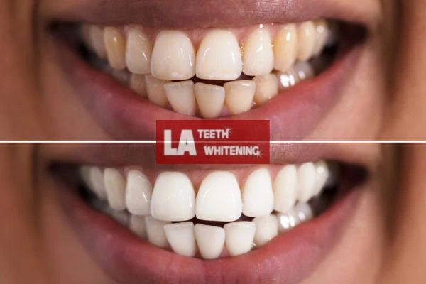 Fast and effective whitening results in one hour. Contact LA Teeth Whitening Dunstable to book online Dunstable