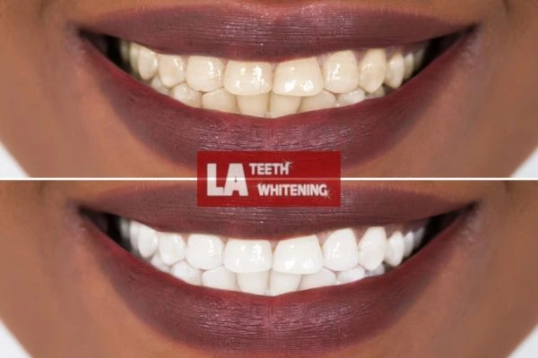 Brighter and white smile - before and after results Dunstable book online today! Dunstable