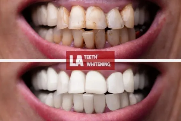 Customer results from LA Teeth Whitening Dunstable Book today. Dunstable