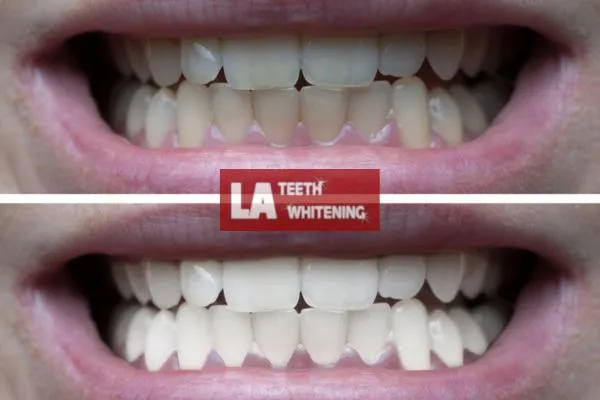 Mens before and after of teeth whitening results Dunstable Dunstable