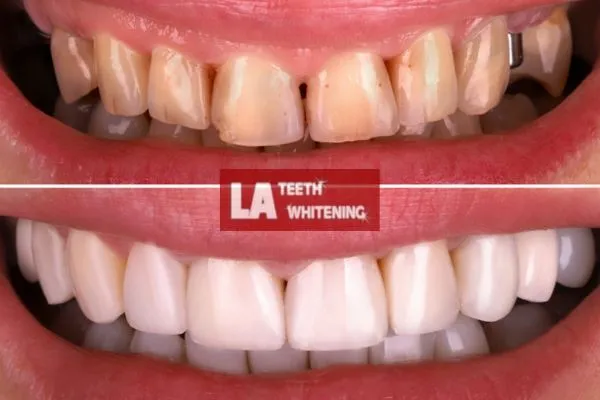yellow teeth from coffee drinking before and after laser teeth whitening results Dunstable