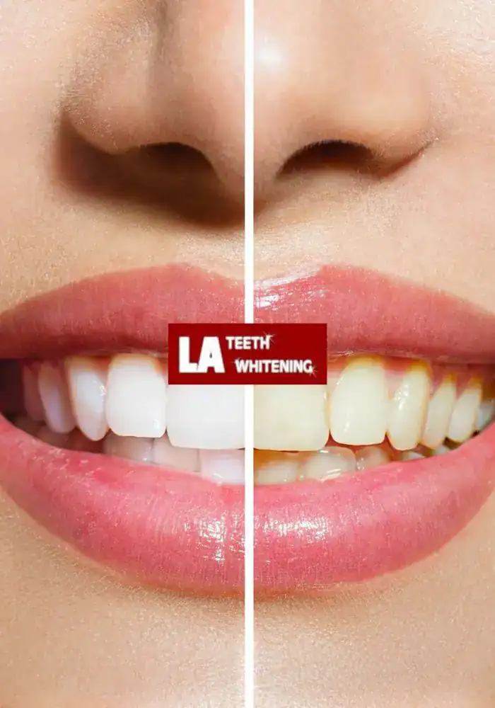 Why Don&rsquo;t Porcelain and Resin Whiten the Same Way as Enamel Dunstable