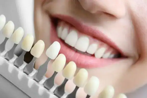 laser whitening Faqs Dunstable